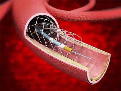 Artery openers - STENTS